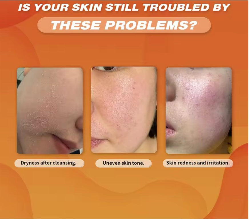 Turmeric Facial Cleanser – Anti Acne, Oil Control & Blackhead Remover