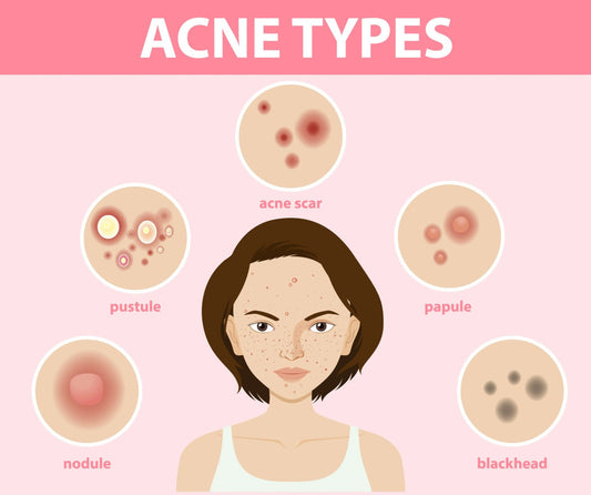 Acne: Causes, Prevention & Treatment - A Dermatologist's Complete Guide